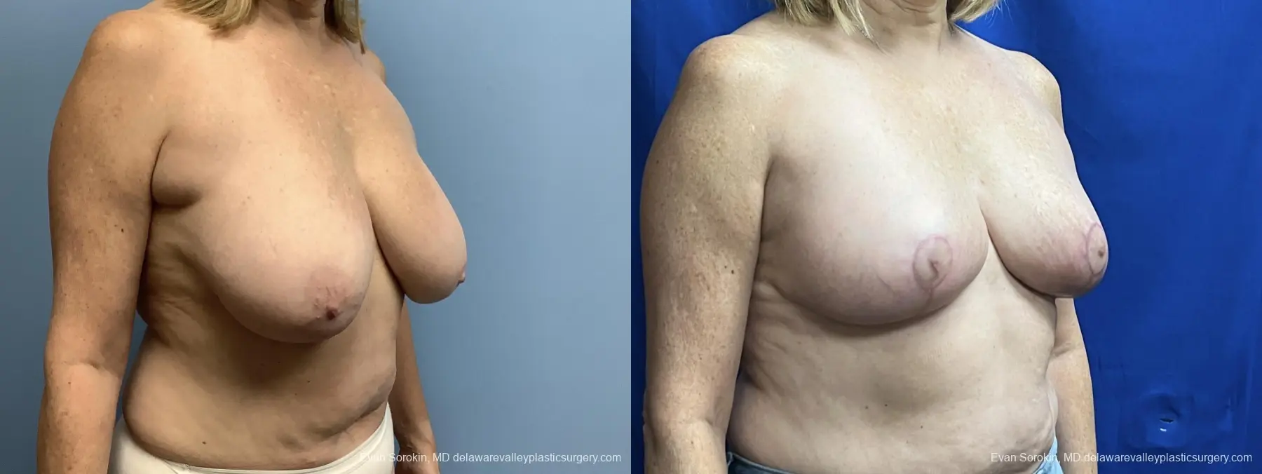 Breast Lift: Patient 6 - Before and After 2