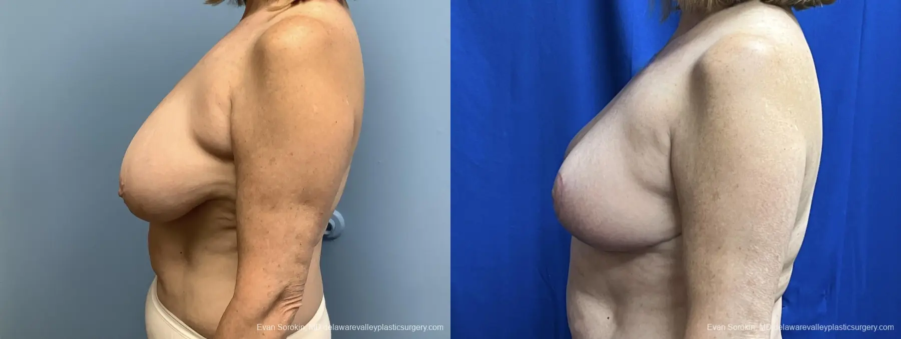 Breast Lift: Patient 6 - Before and After 5