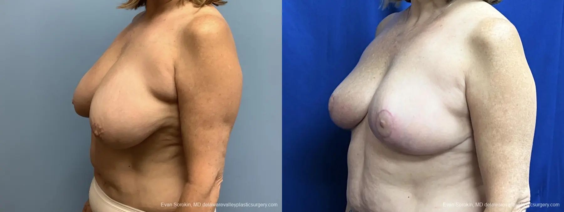 Breast Lift: Patient 6 - Before and After 4