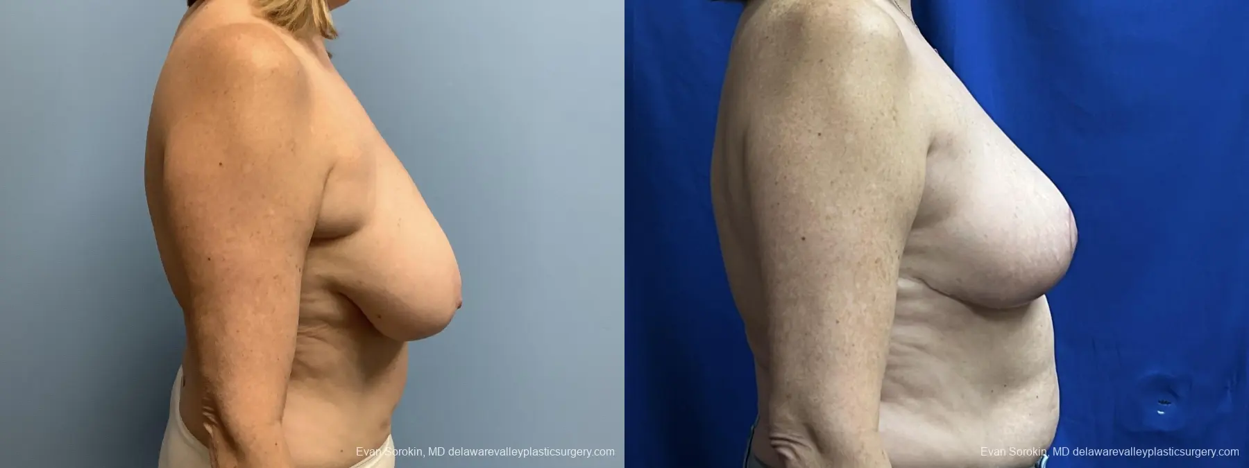 Breast Lift: Patient 6 - Before and After 3