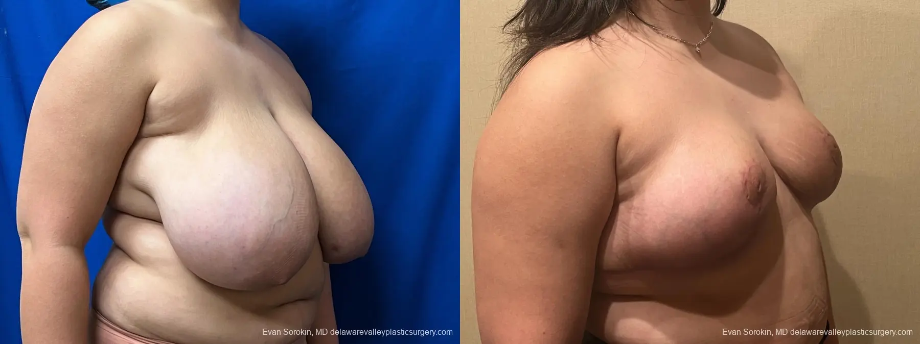 Breast Reduction: Patient 12 - Before and After 2