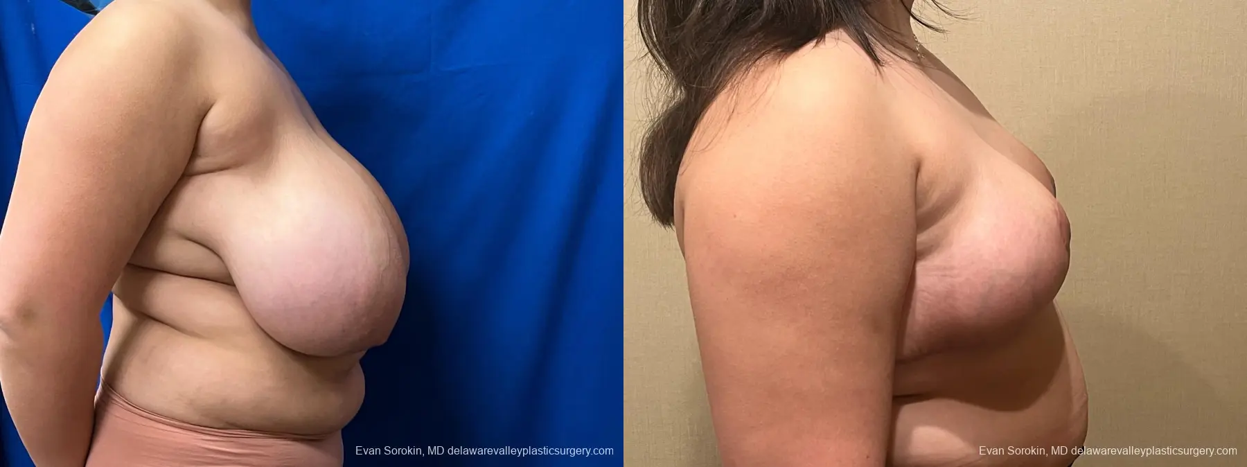 Breast Reduction: Patient 12 - Before and After 3