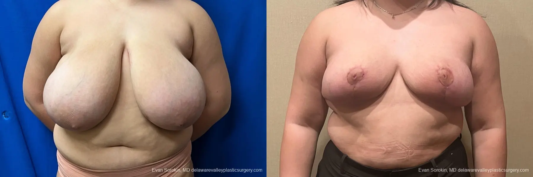 Breast Reduction: Patient 12 - Before and After  