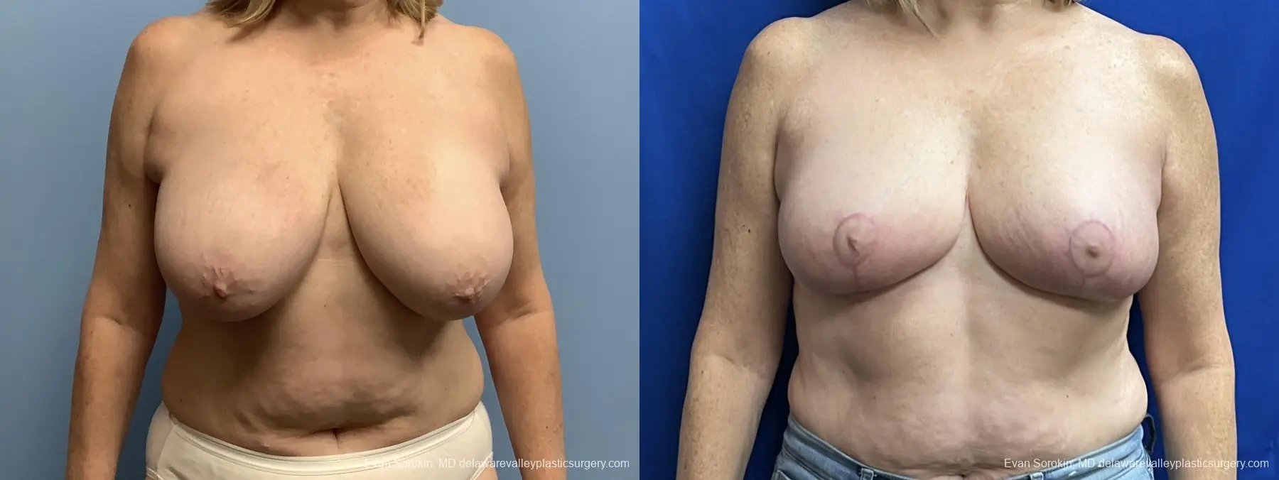 Breast Reduction: Patient 6 - Before and After  