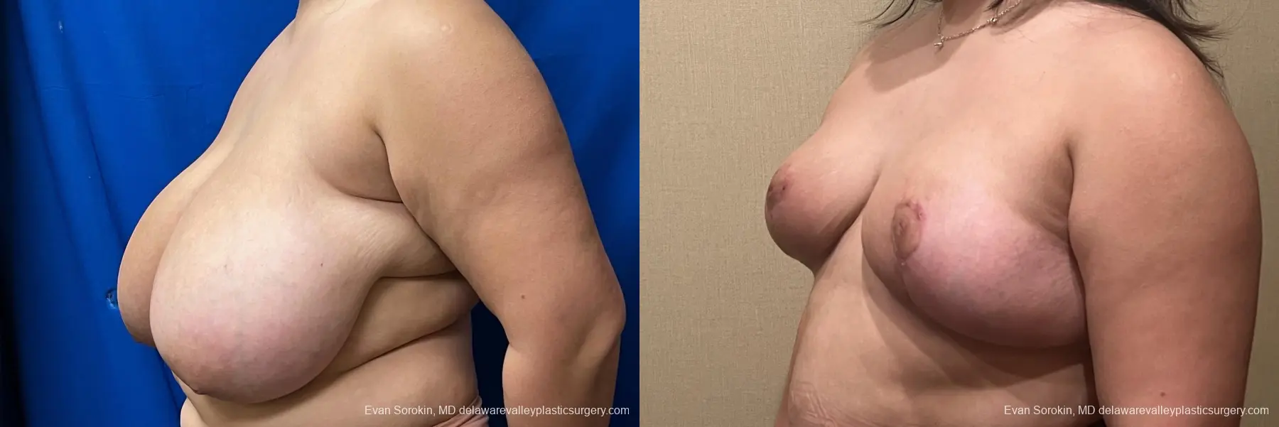 Breast Reduction: Patient 12 - Before and After 4