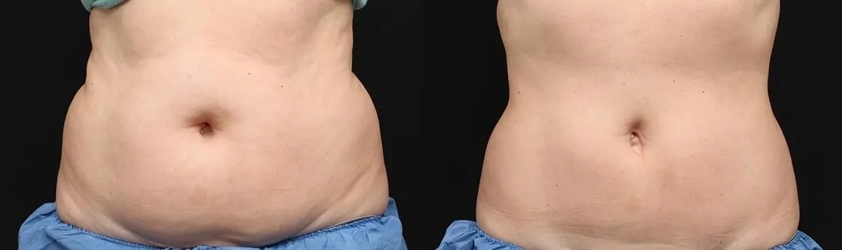 CoolSculpting®: Patient 6 - Before and After 1