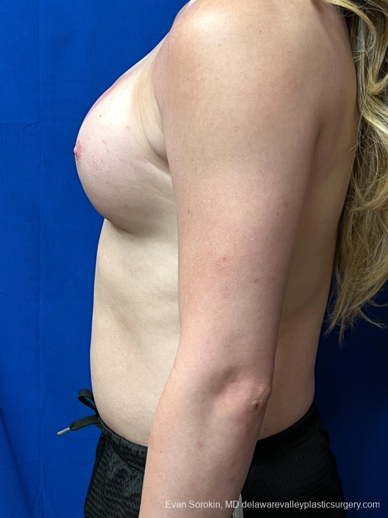 Breast Augmentation: Patient 268 - After 5