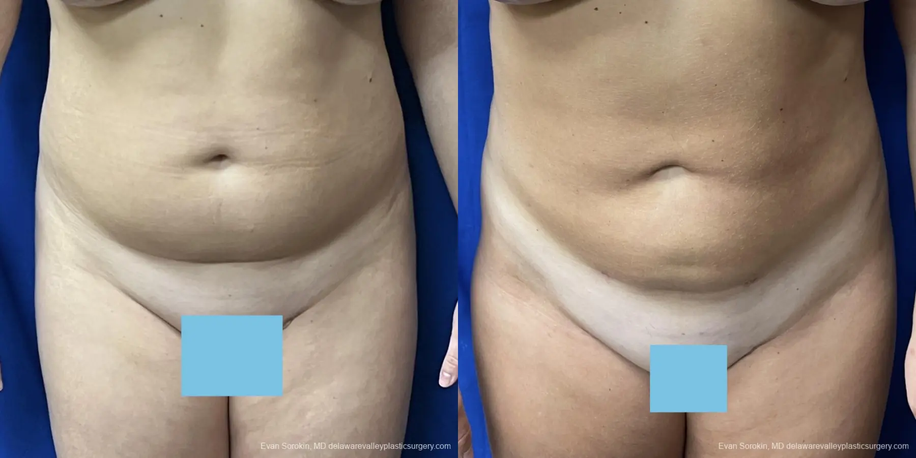 Liposuction: Patient 11 - Before and After  