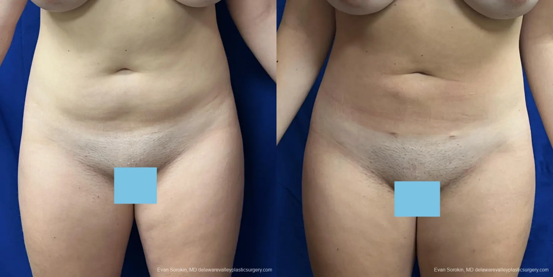 Liposuction: Patient 10 - Before and After  