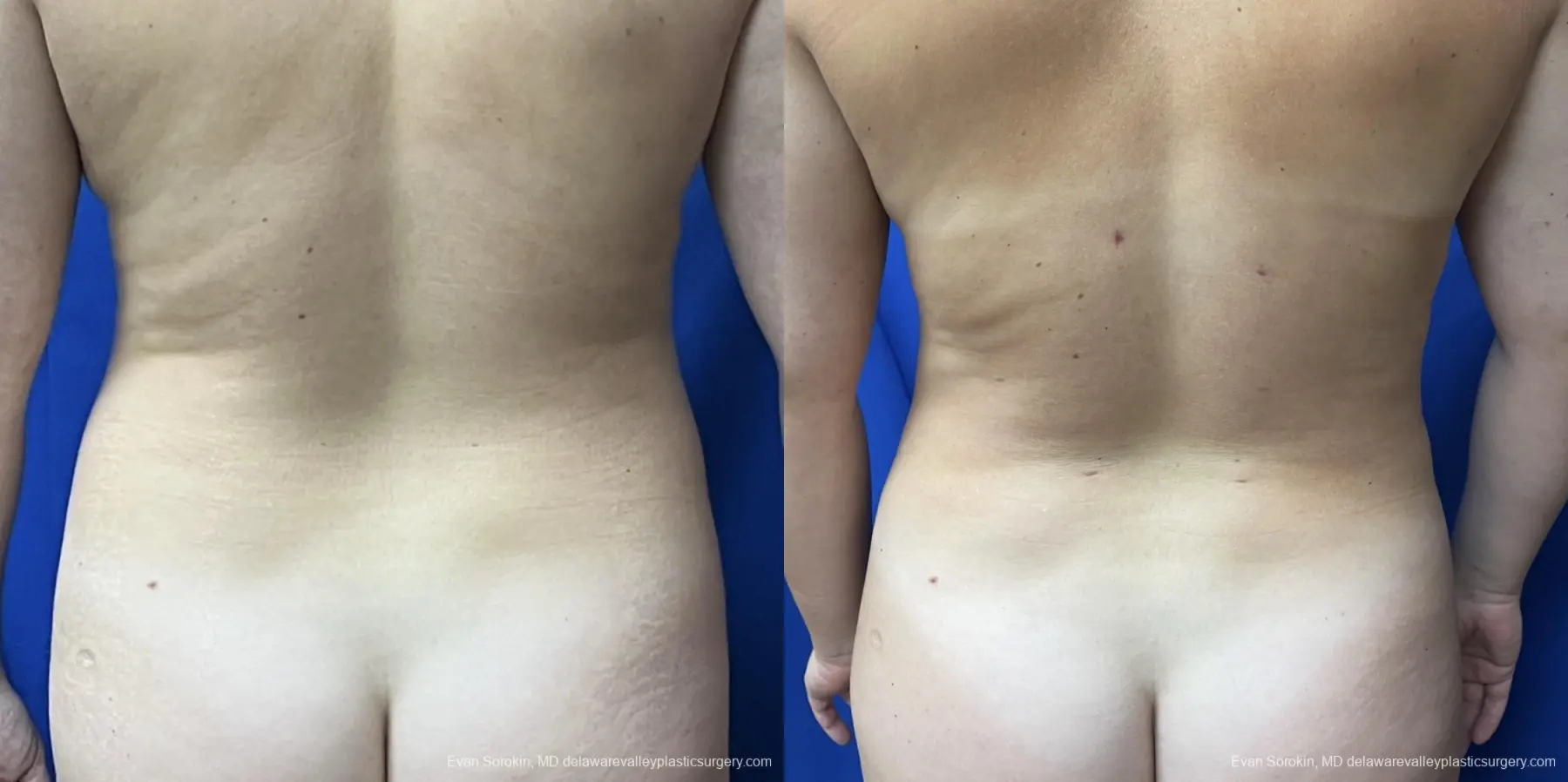 Liposuction: Patient 11 - Before and After 3