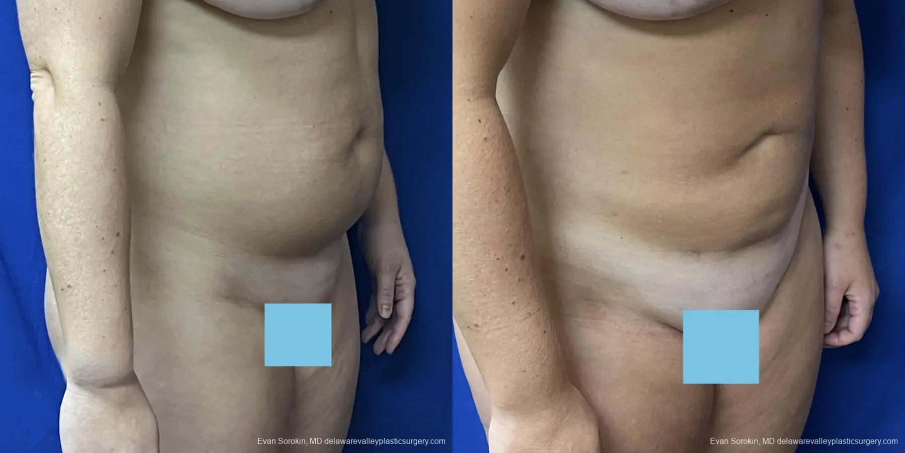 Liposuction: Patient 11 - Before and After 2