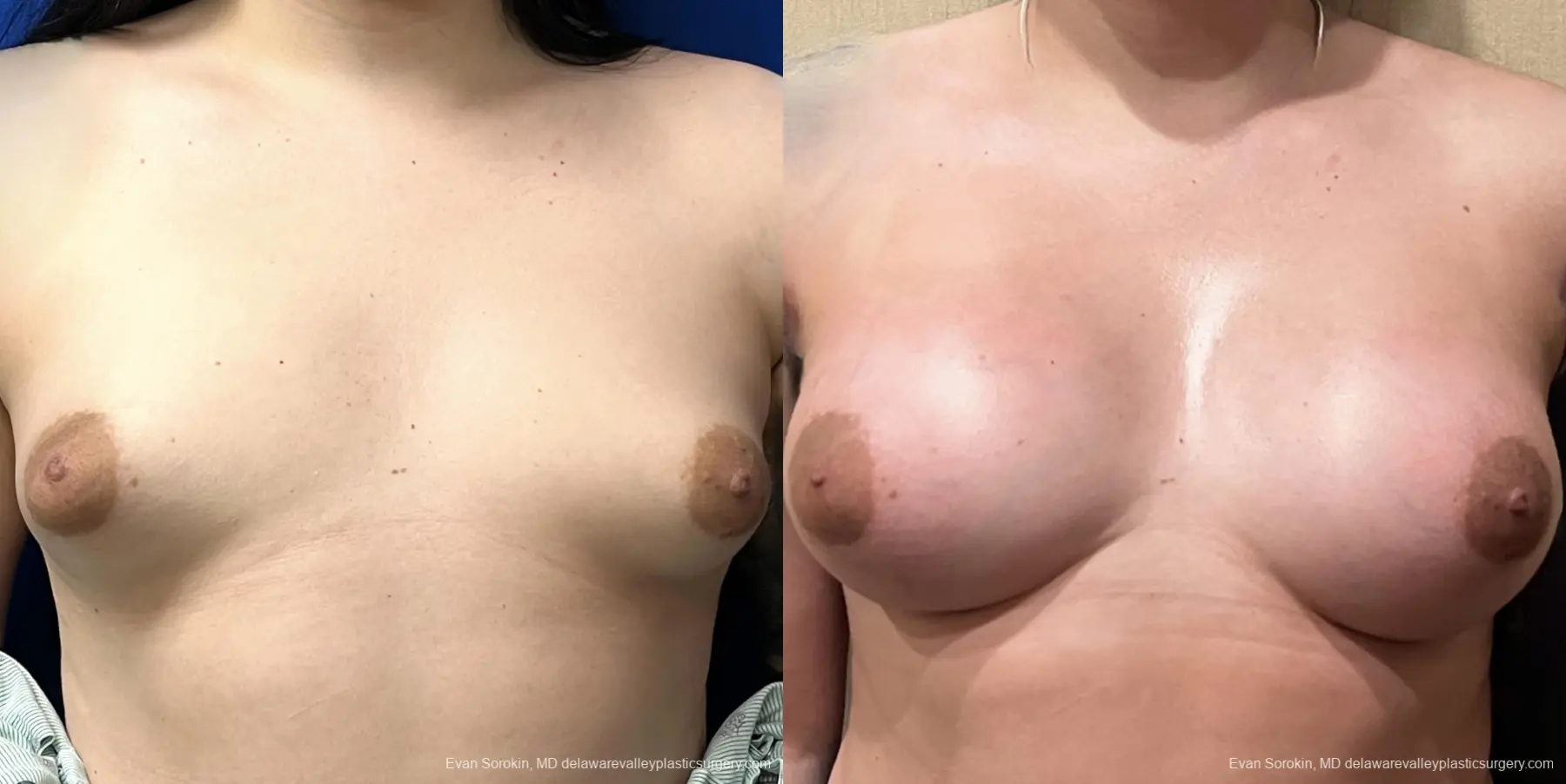 Top Surgery: Patient 4 - Before and After  