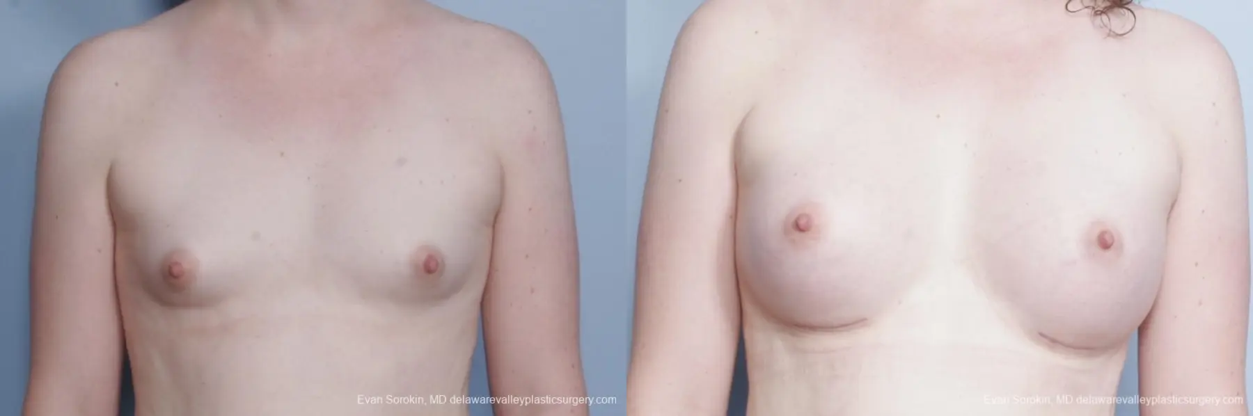 Philadelphia Top Surgery Male to Female 8642 - Before and After