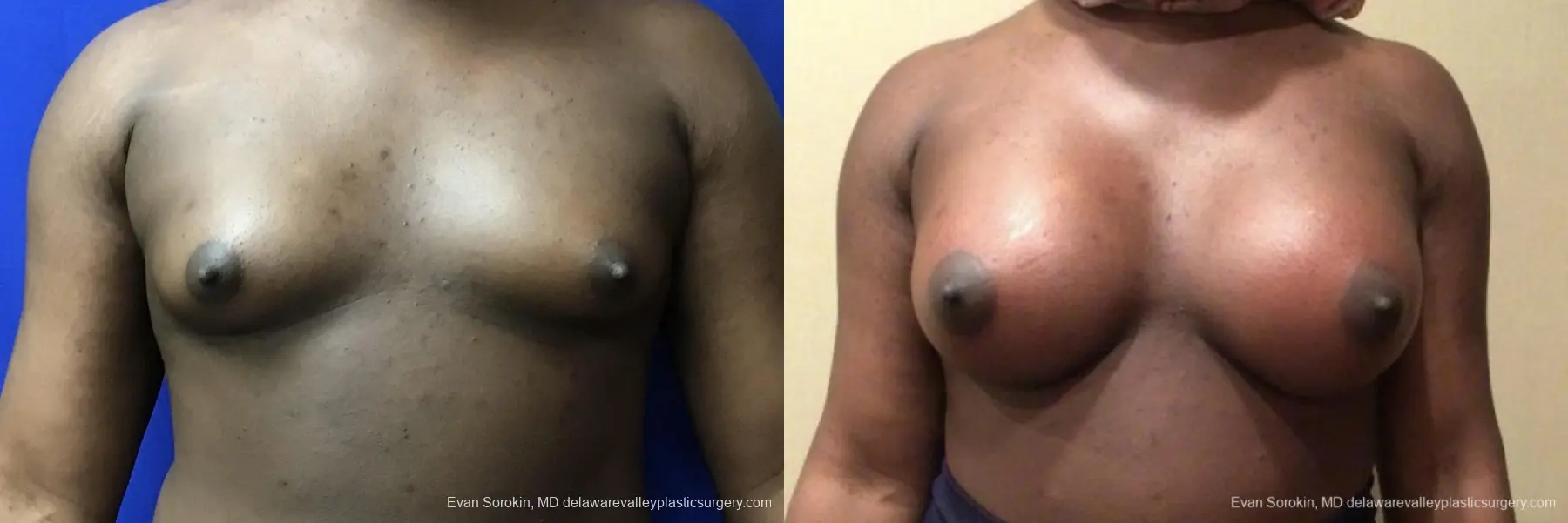 Top Surgery: Patient 3 - Before and After  