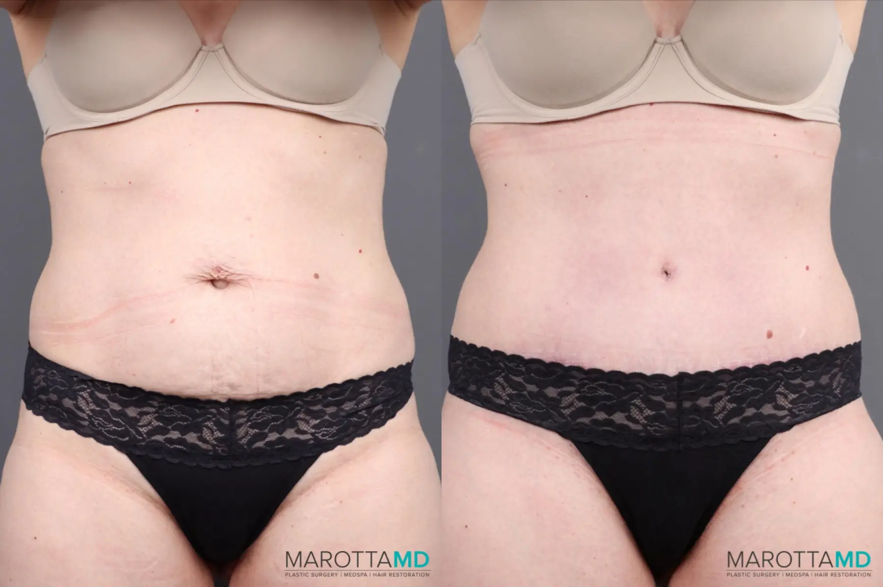 Abdominoplasty: Patient 2 - Before and After  