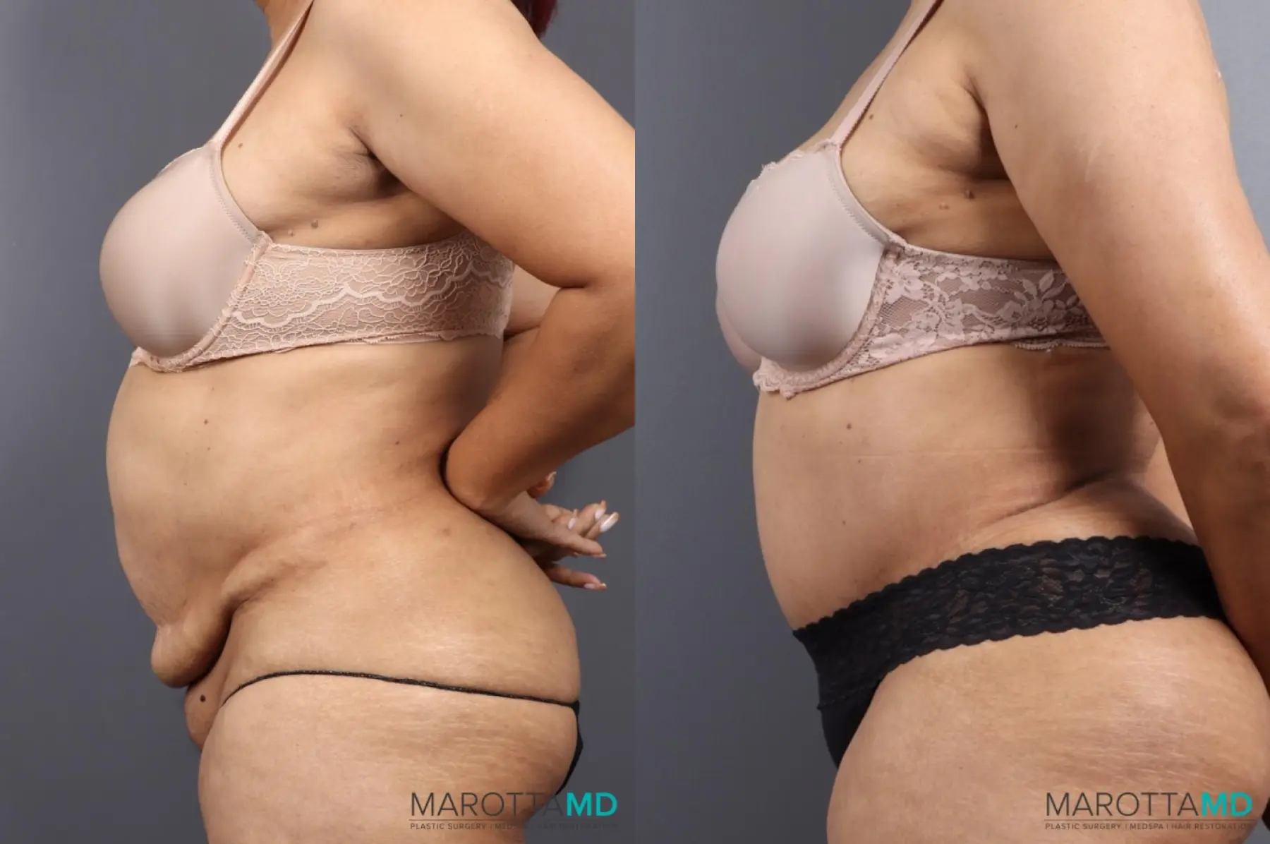 Abdominoplasty: Patient 4 - Before and After  