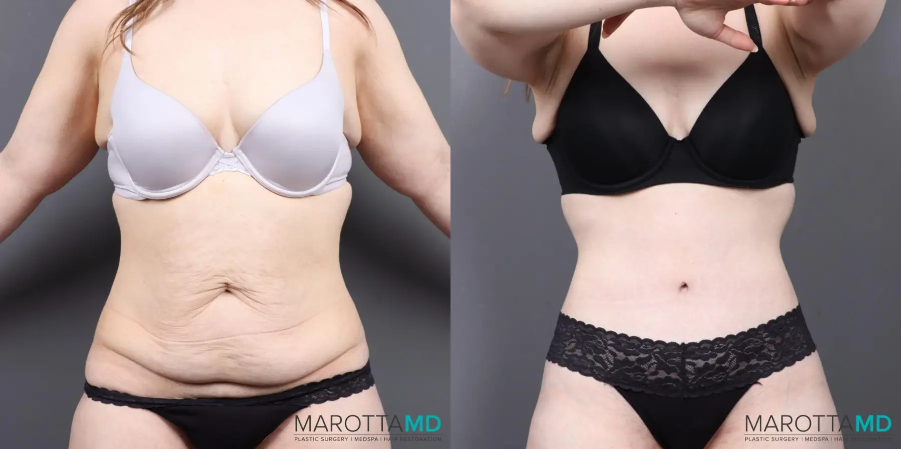 Abdominoplasty: Patient 1 - Before and After  