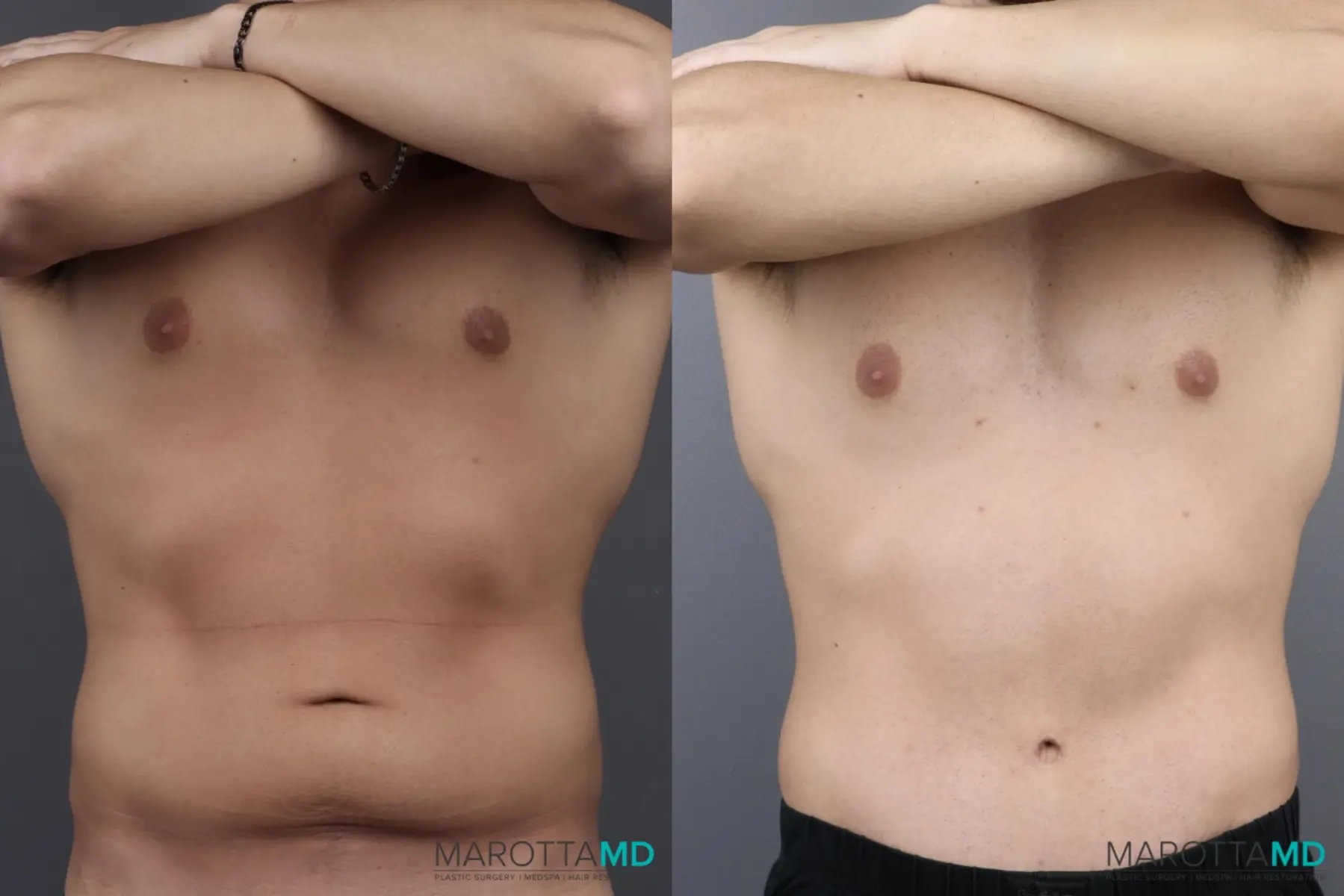 Abdominoplasty: Patient 5 - Before and After  