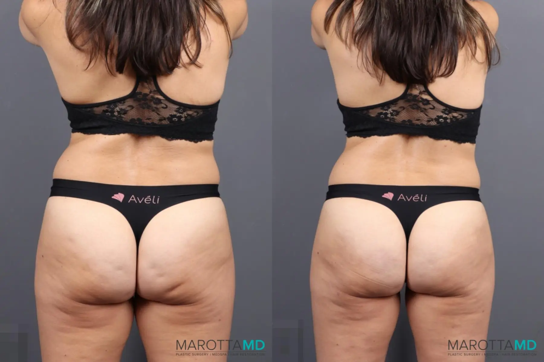 Cellulite Reduction - Before and After  