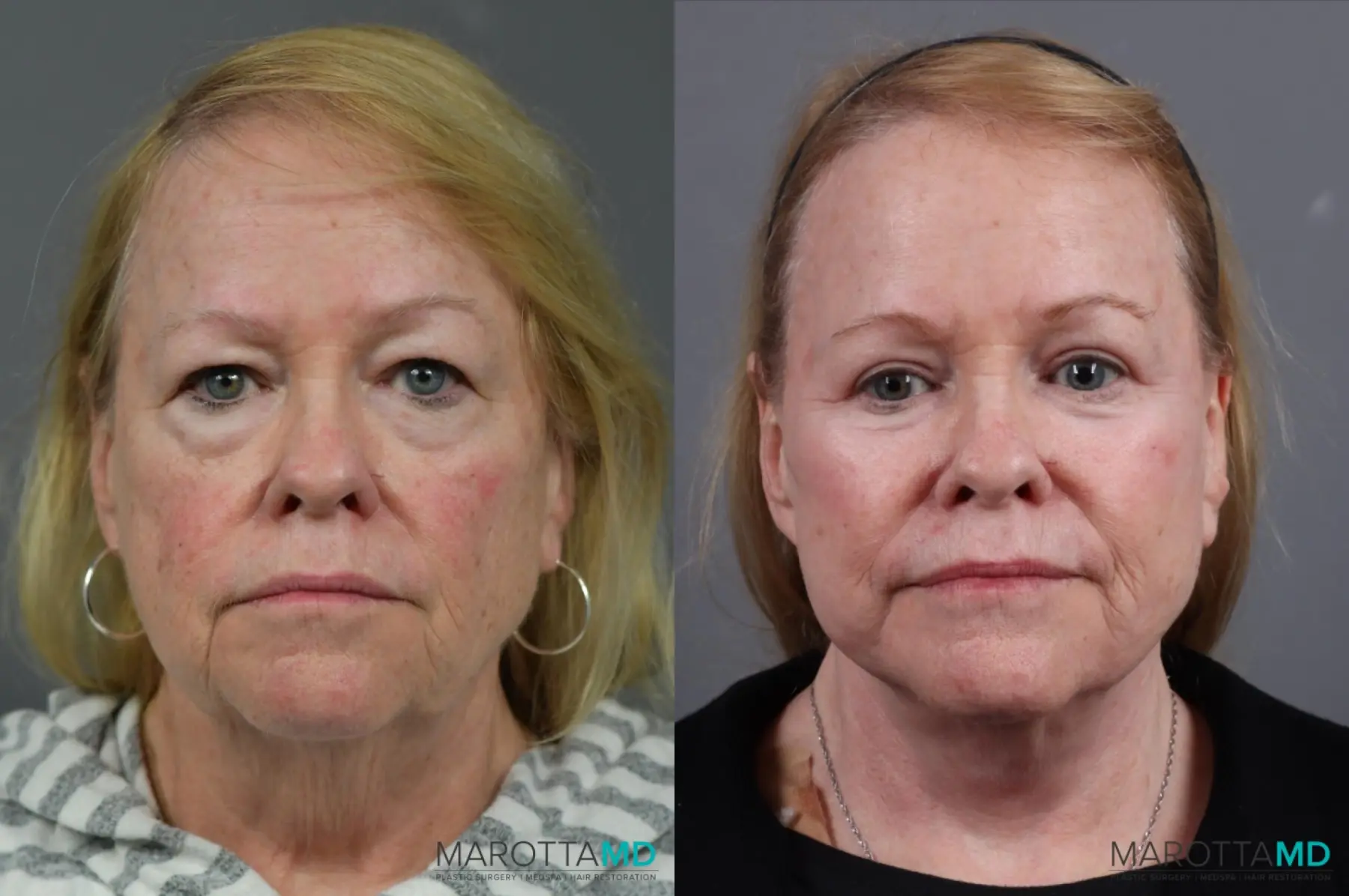 Blepharoplasty: Patient 4 - Before and After  