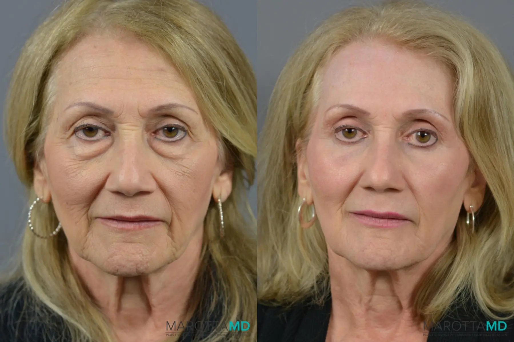 Blepharoplasty: Patient 1 - Before and After  