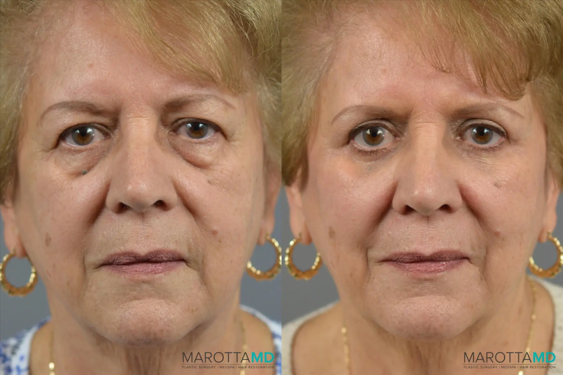 Blepharoplasty: Patient 2 - Before and After  