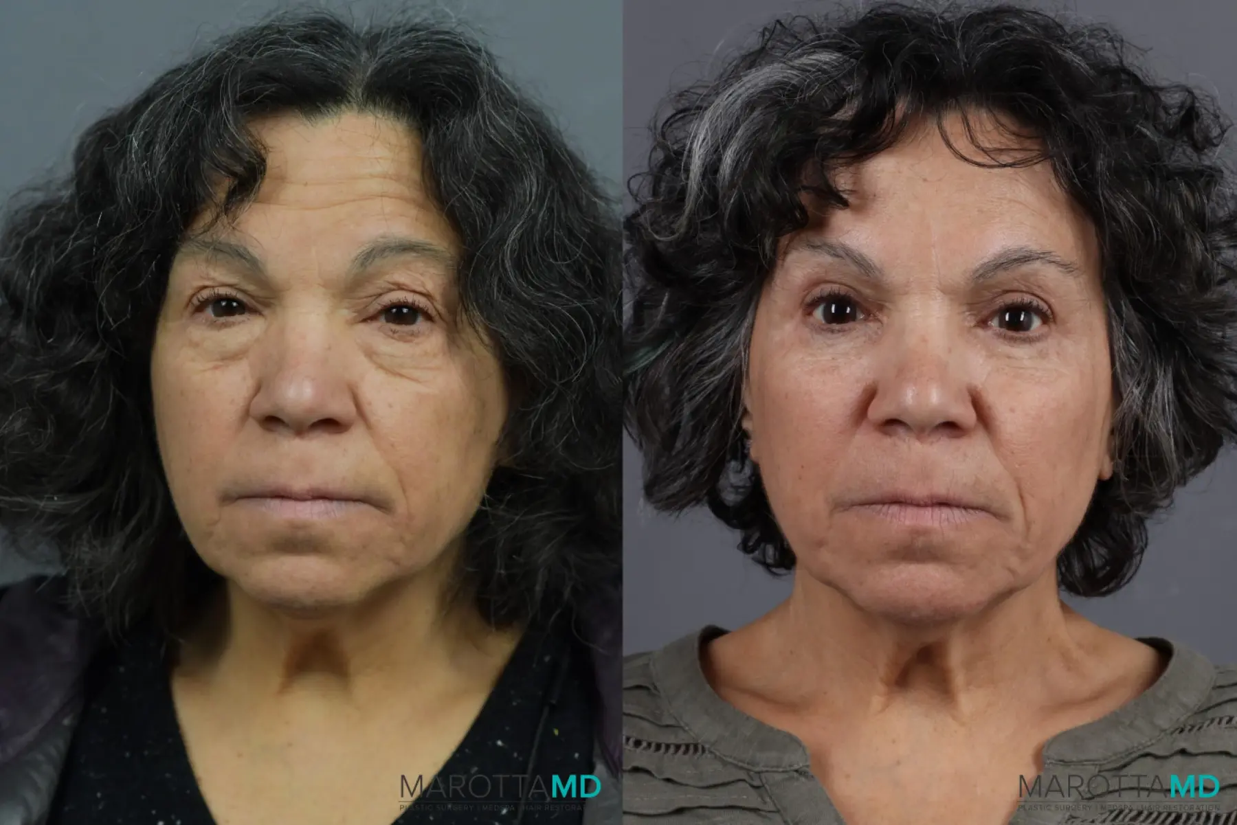 Blepharoplasty: Patient 5 - Before and After  