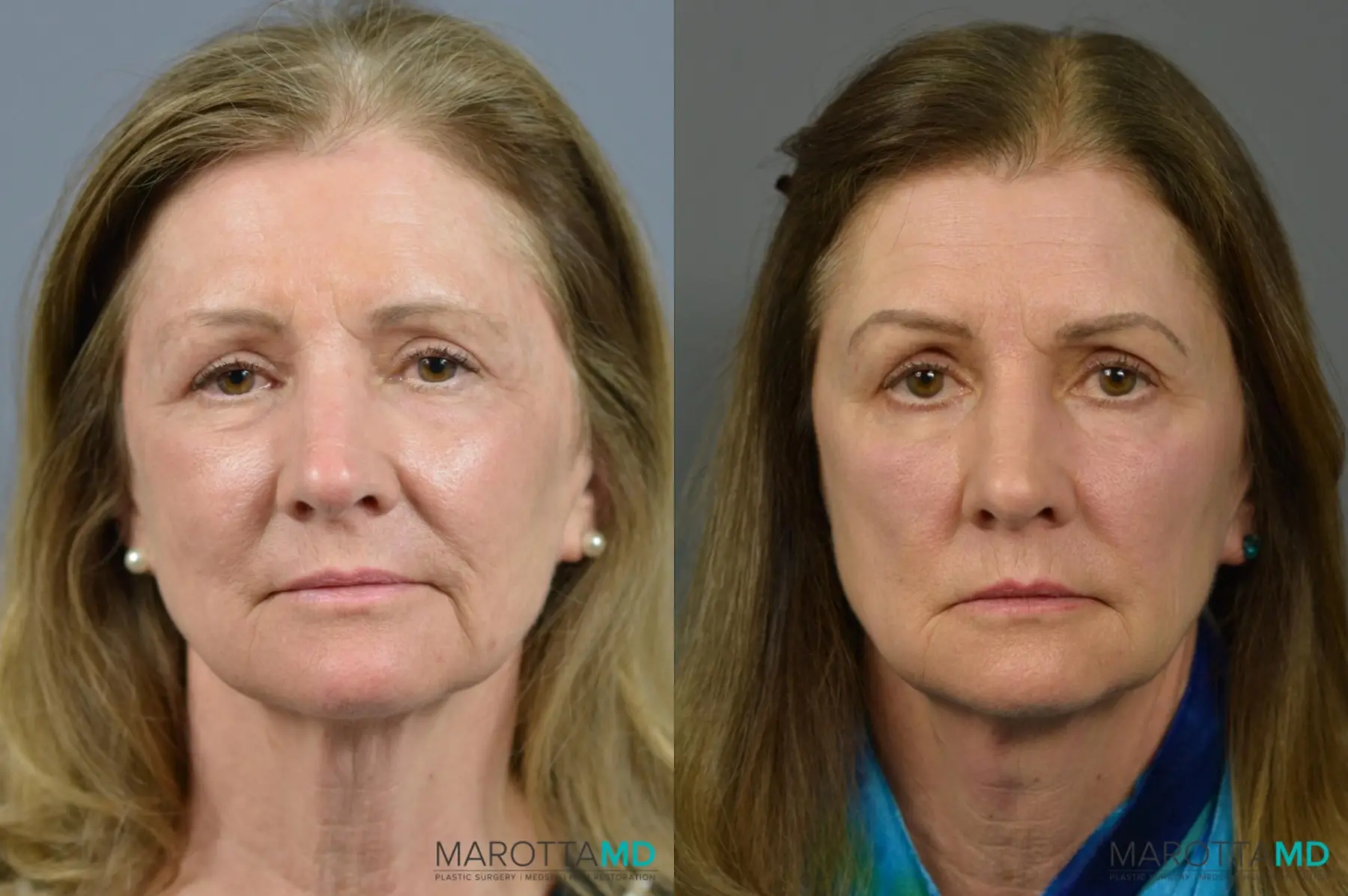 Blepharoplasty: Patient 10 - Before and After  