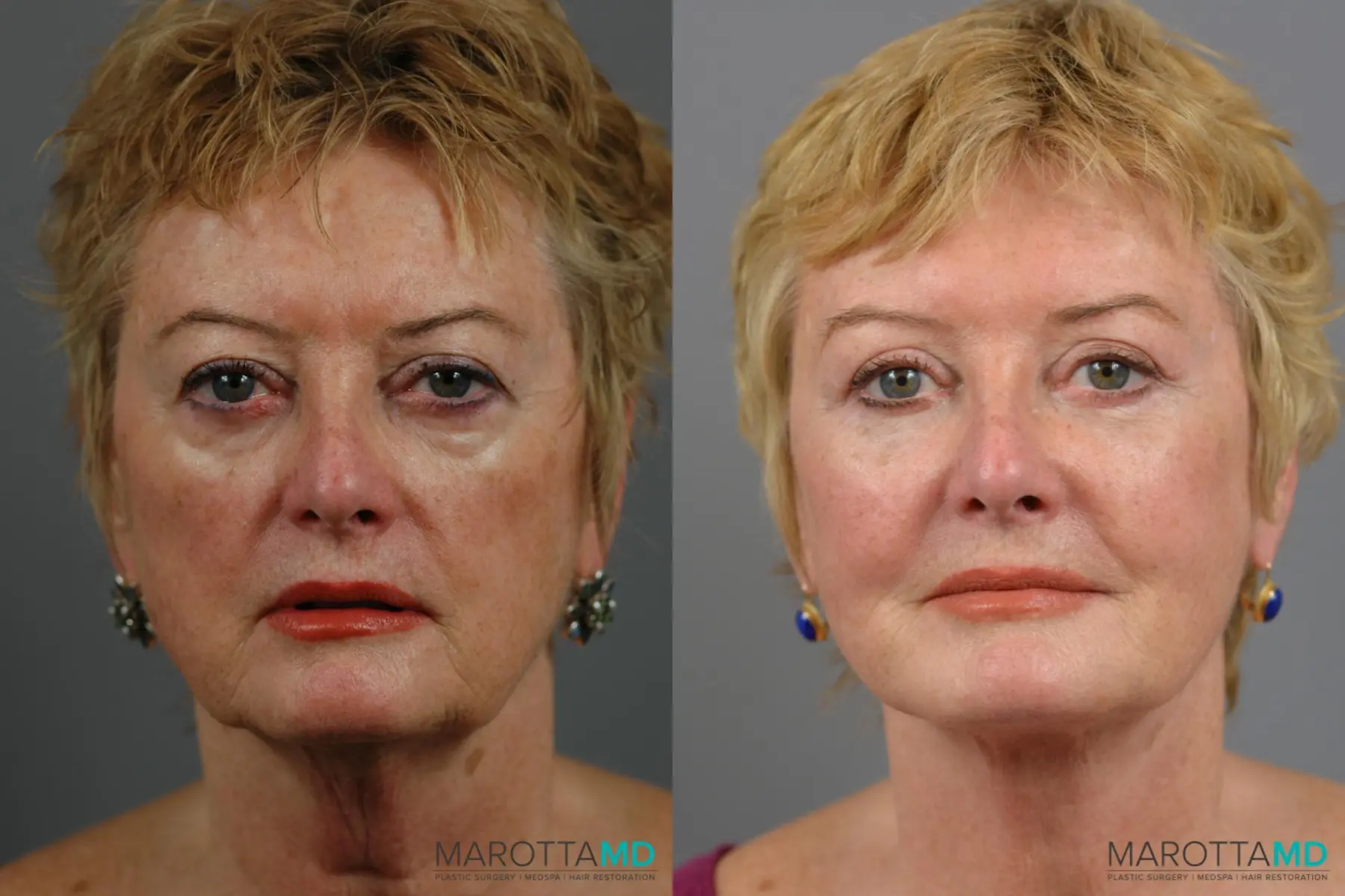 Blepharoplasty: Patient 7 - Before and After  