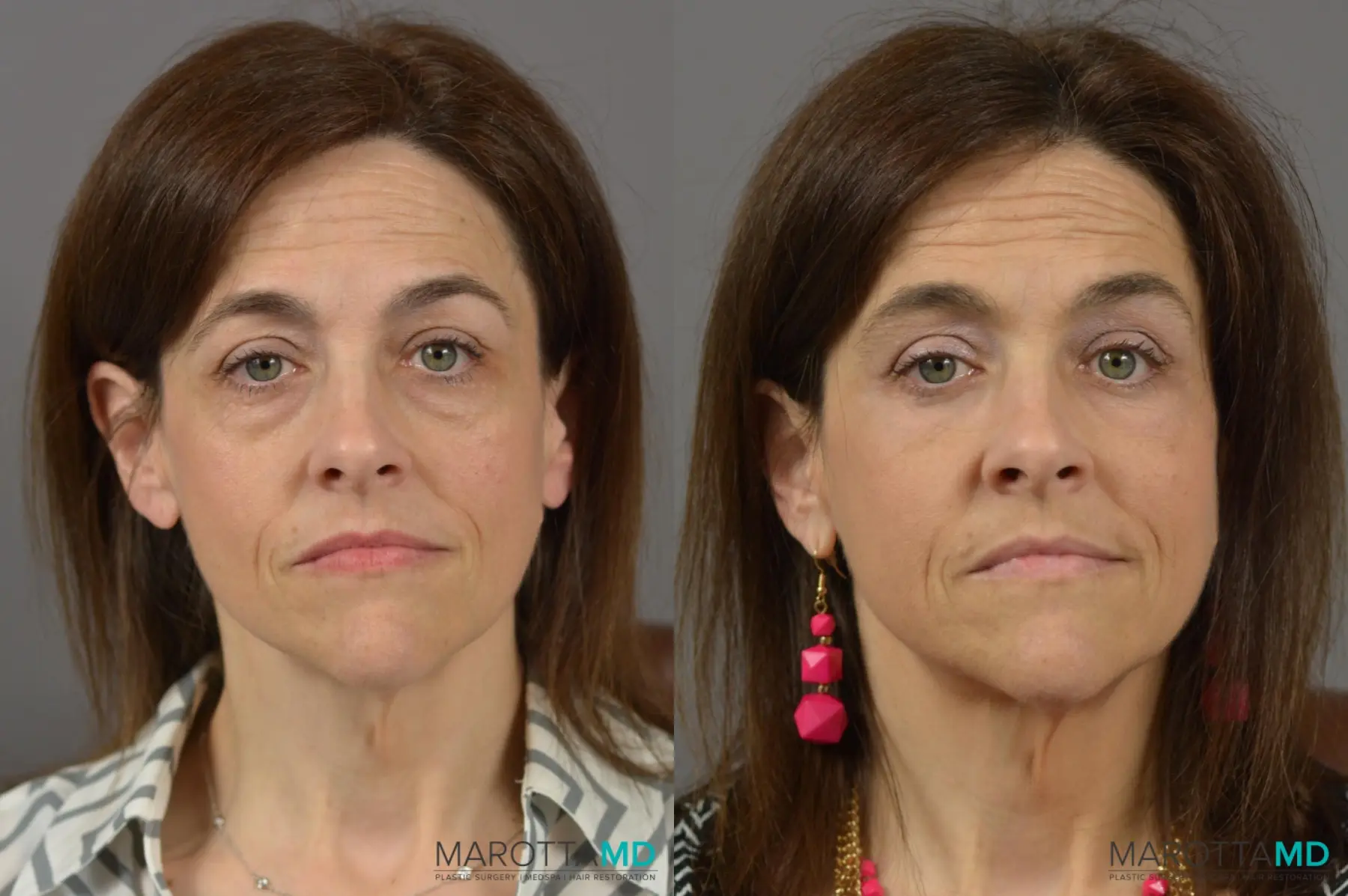 Blepharoplasty: Patient 8 - Before and After  