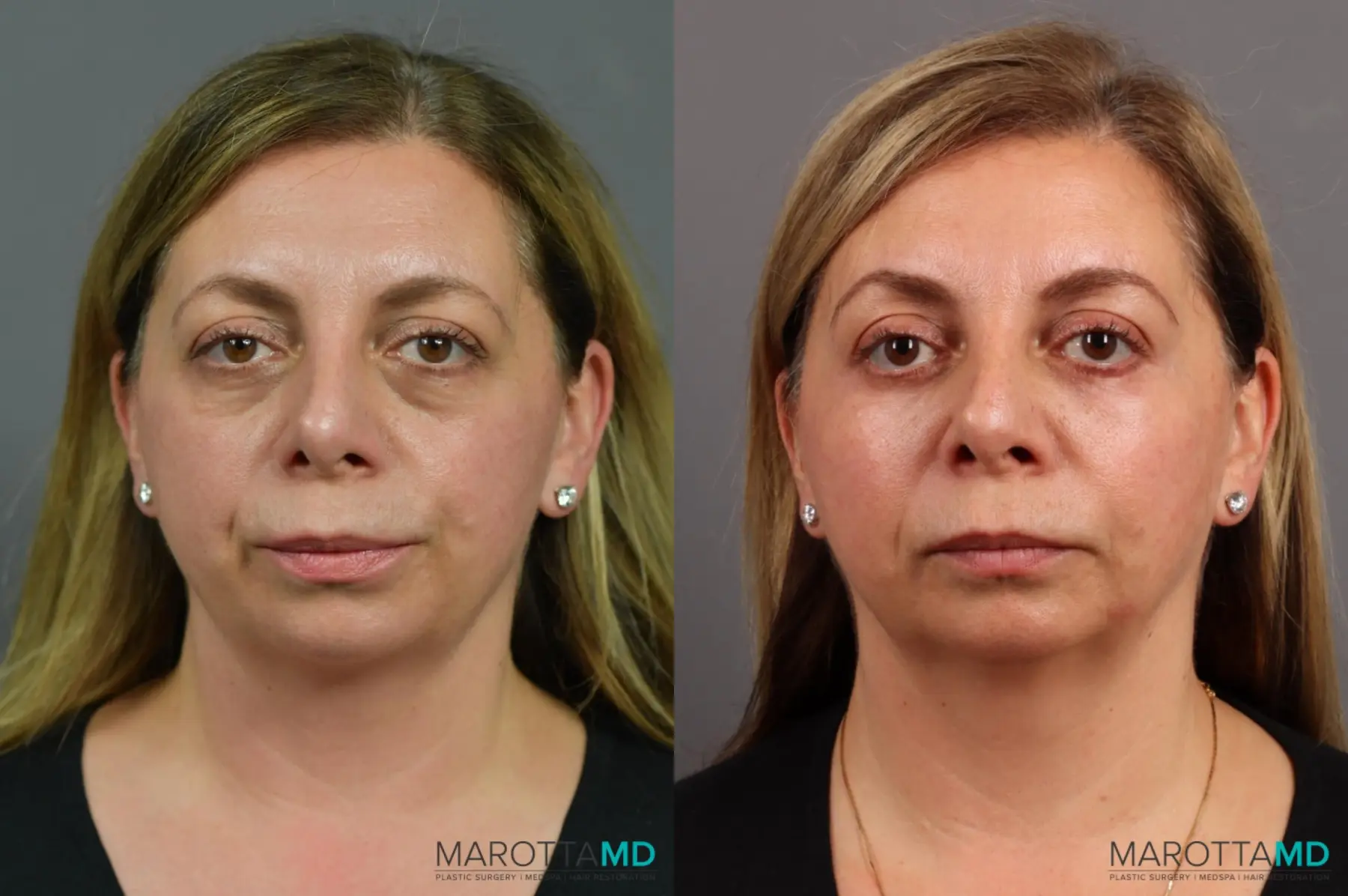 Blepharoplasty: Patient 6 - Before and After  