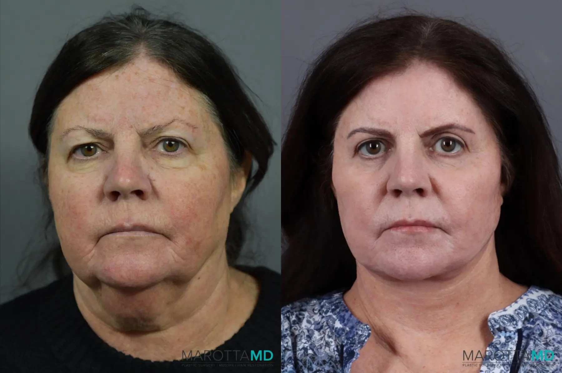 Blepharoplasty: Patient 9 - Before and After  