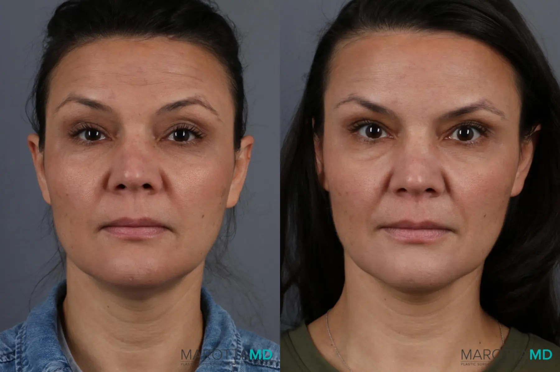 Botox - Chin: Patient 3 - Before and After  