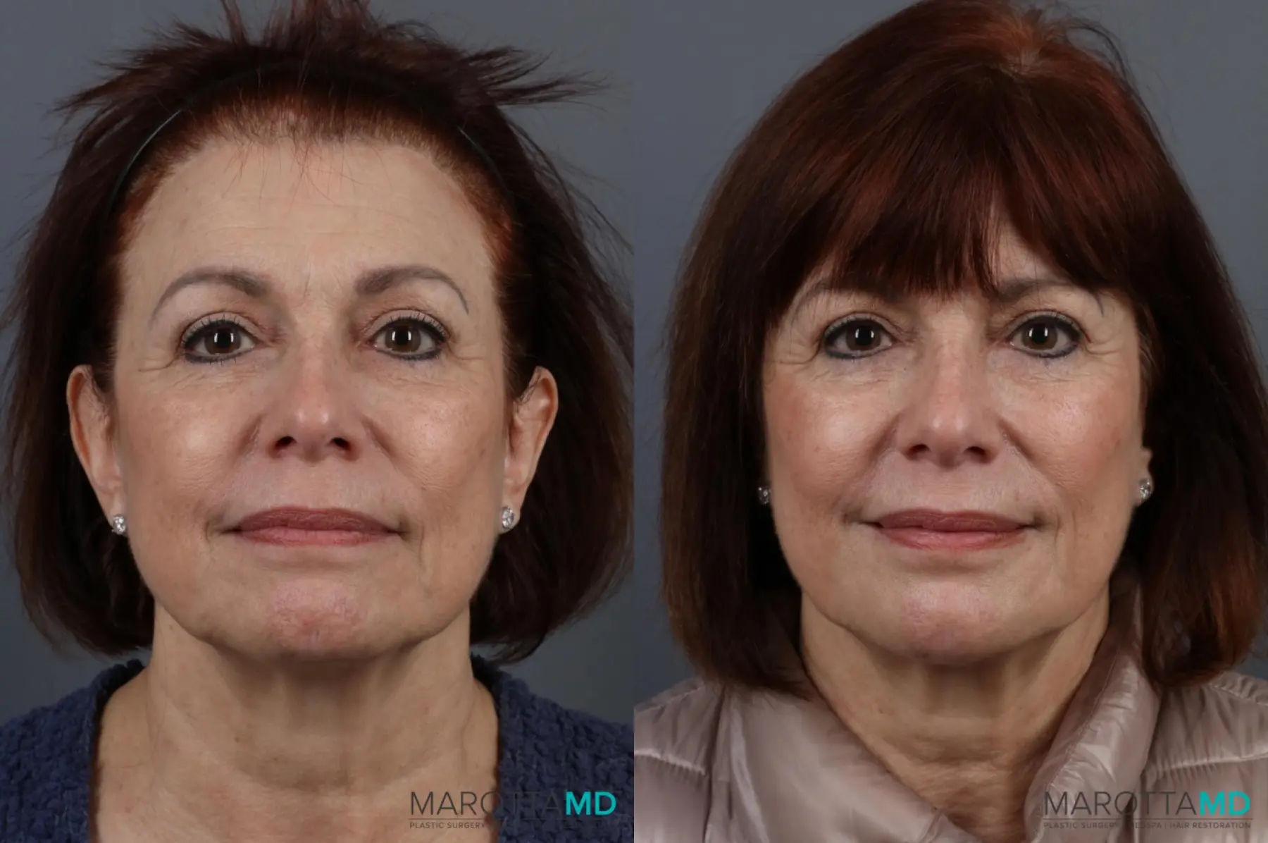 Botox - Chin: Patient 1 - Before and After  