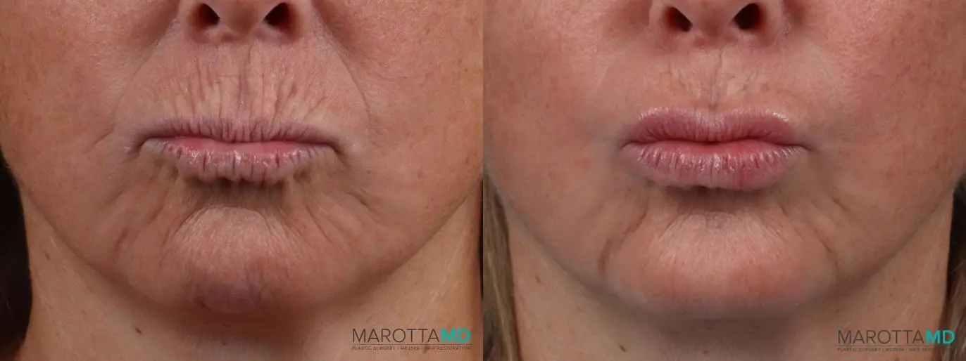 Botox - Chin: Patient 1 - Before and After  