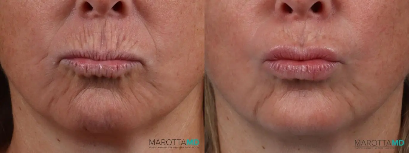 Botox - DAO: Patient 1 - Before and After  