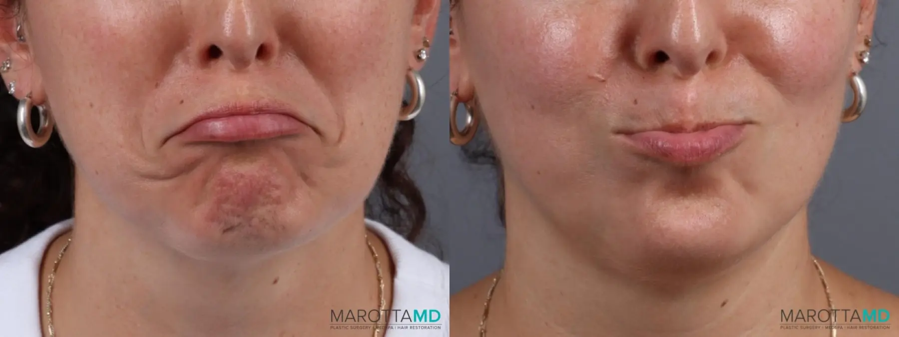 Botox - DAO: Patient 5 - Before and After  