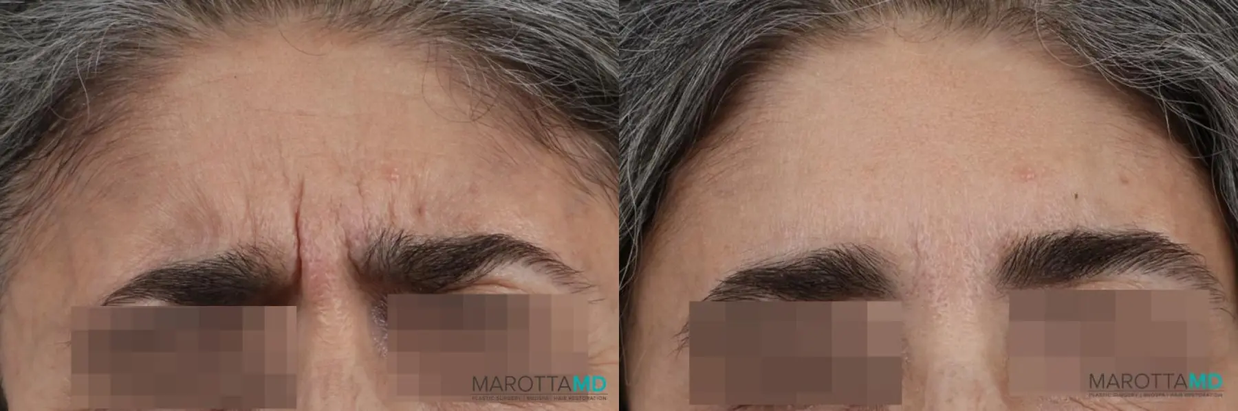 Botox - DAO: Patient 2 - Before and After  