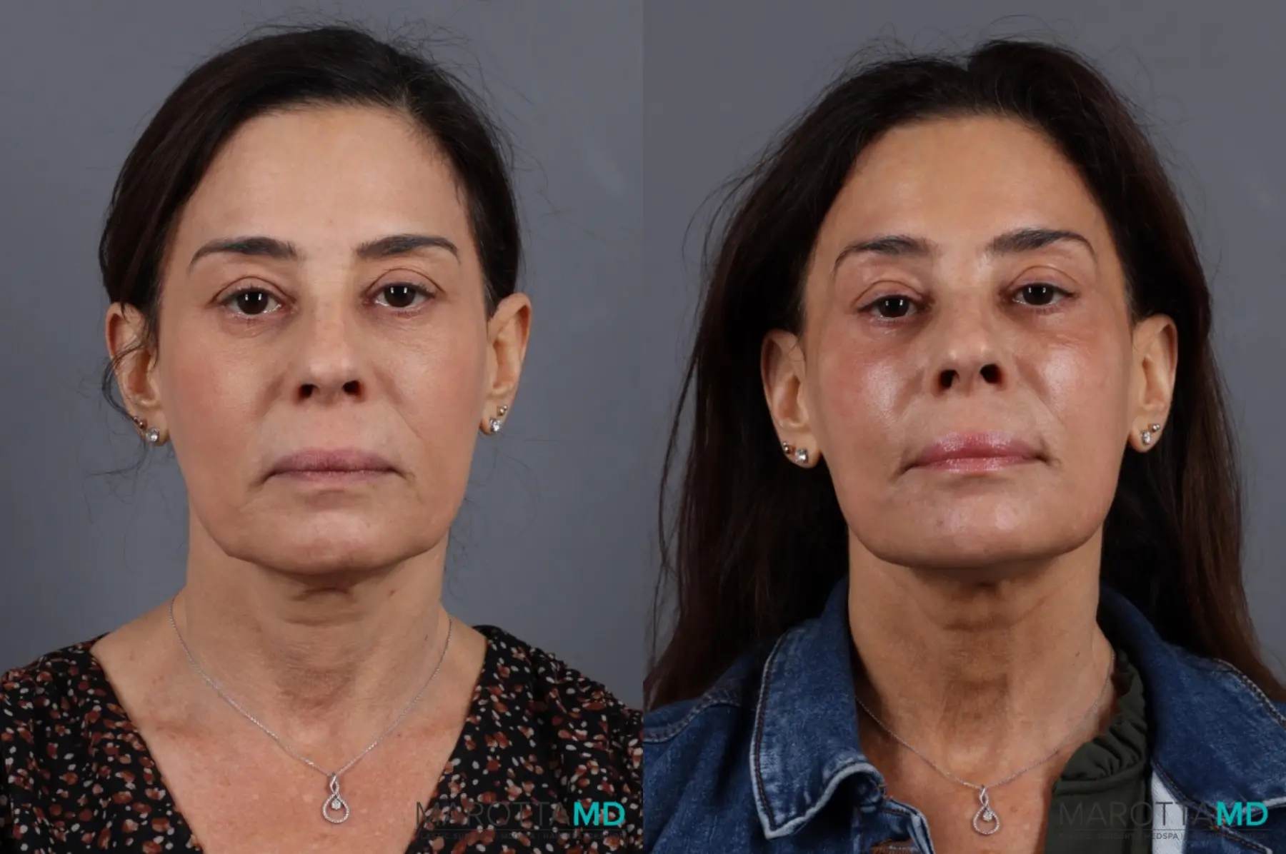 Botox - DAO: Patient 6 - Before and After  