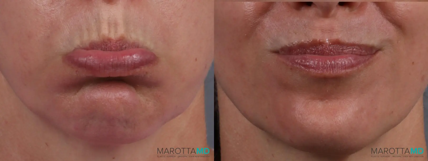 Botox - DAO: Patient 3 - Before and After  