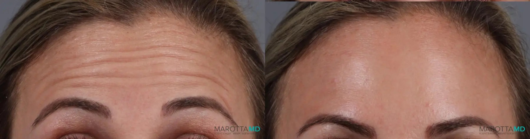 Botox - Forehead: Patient 4 - Before and After  