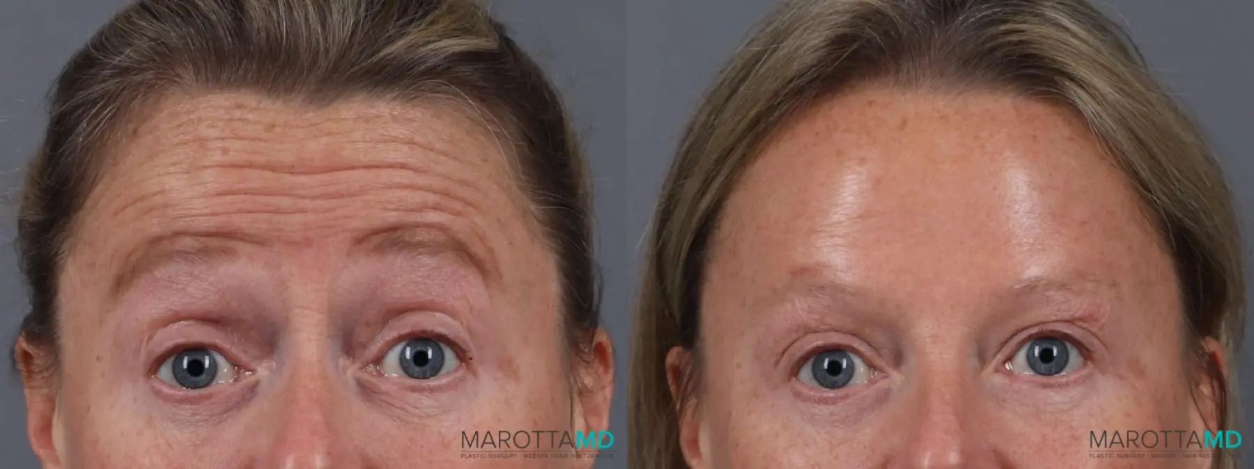 Botox - Forehead: Patient 1 - Before and After  