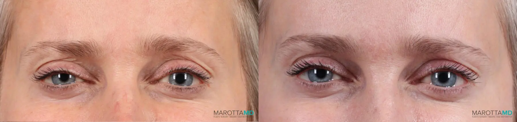 Botox - Forehead: Patient 8 - Before and After  