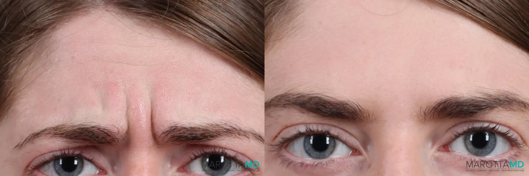 Botox - Forehead: Patient 9 - Before and After  