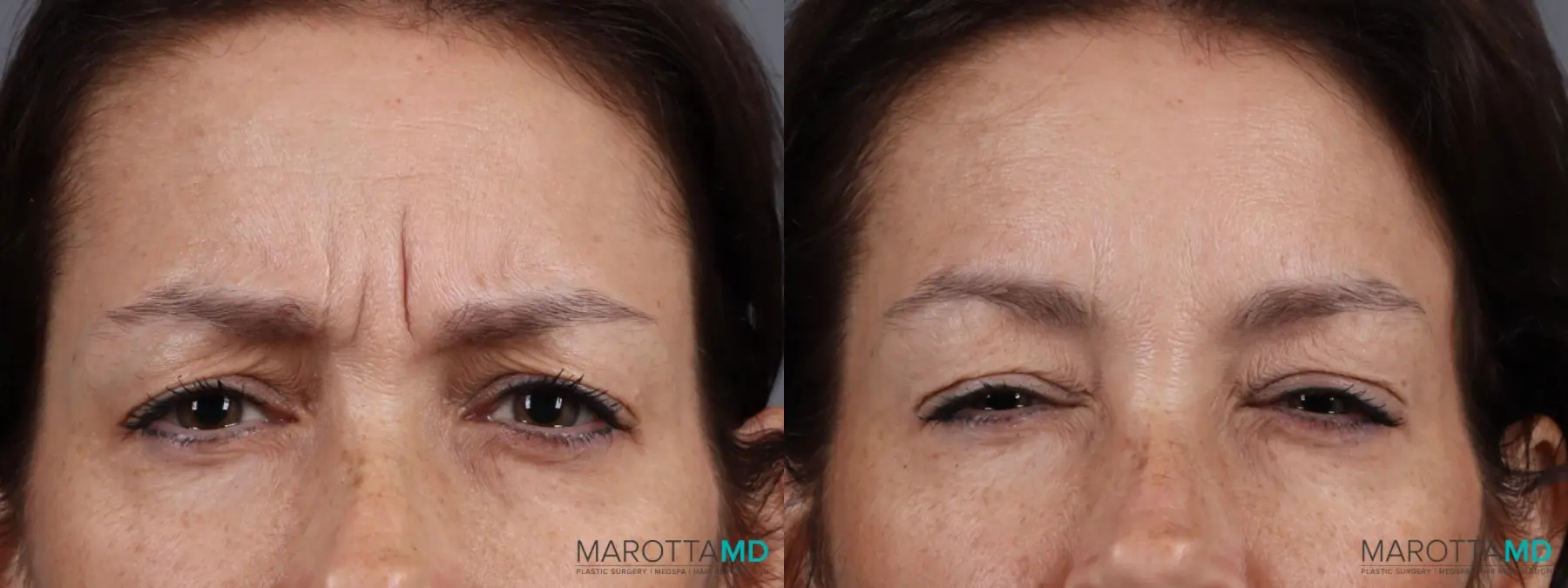 Botox - Forehead: Patient 11 - Before and After  