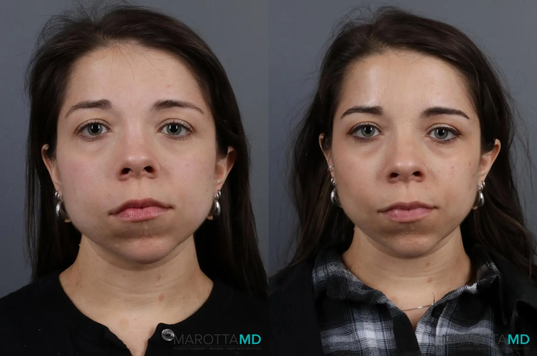 Botox - Forehead: Patient 1 - Before and After  