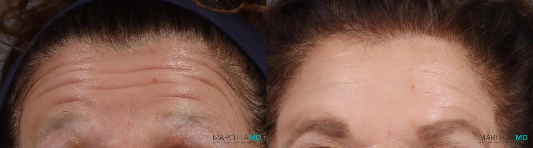 Botox - Forehead: Patient 7 - Before and After  