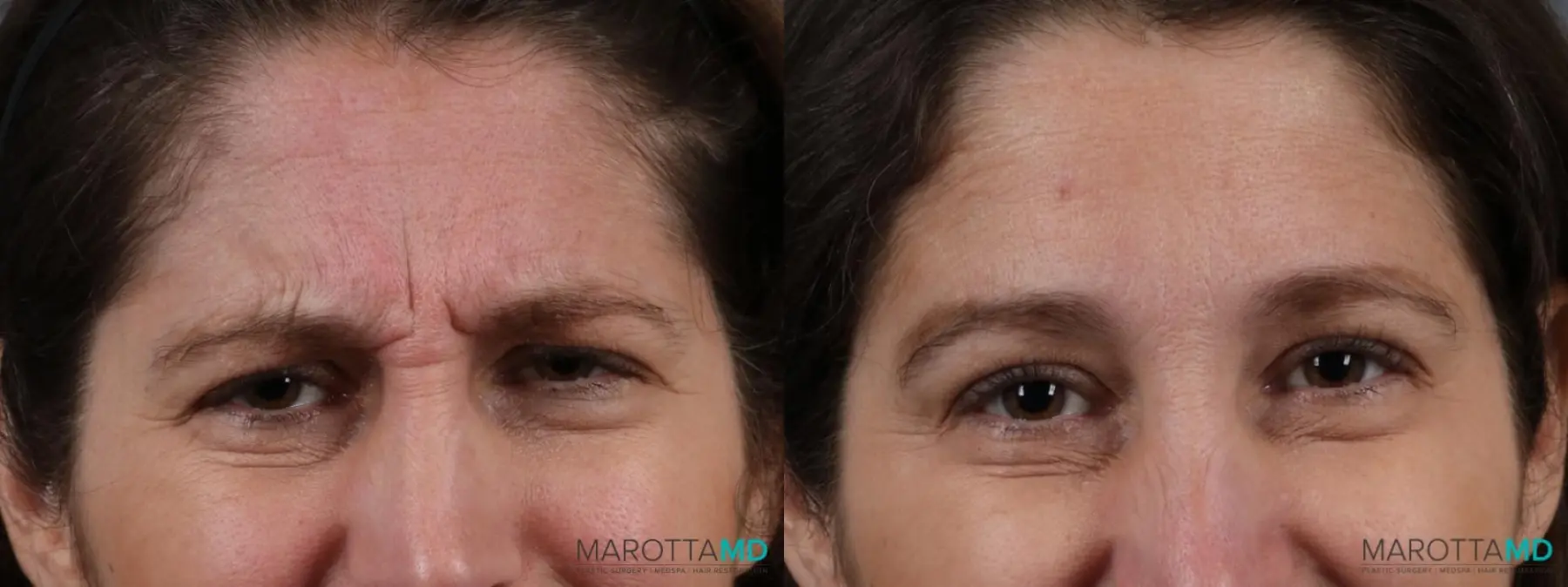 Botox - Forehead: Patient 5 - Before and After  