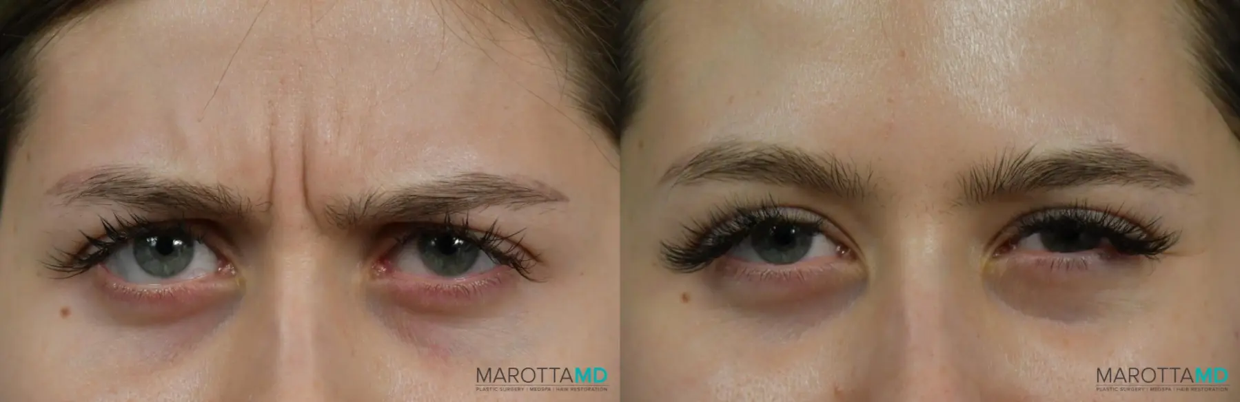 Botox - Forehead: Patient 6 - Before and After  