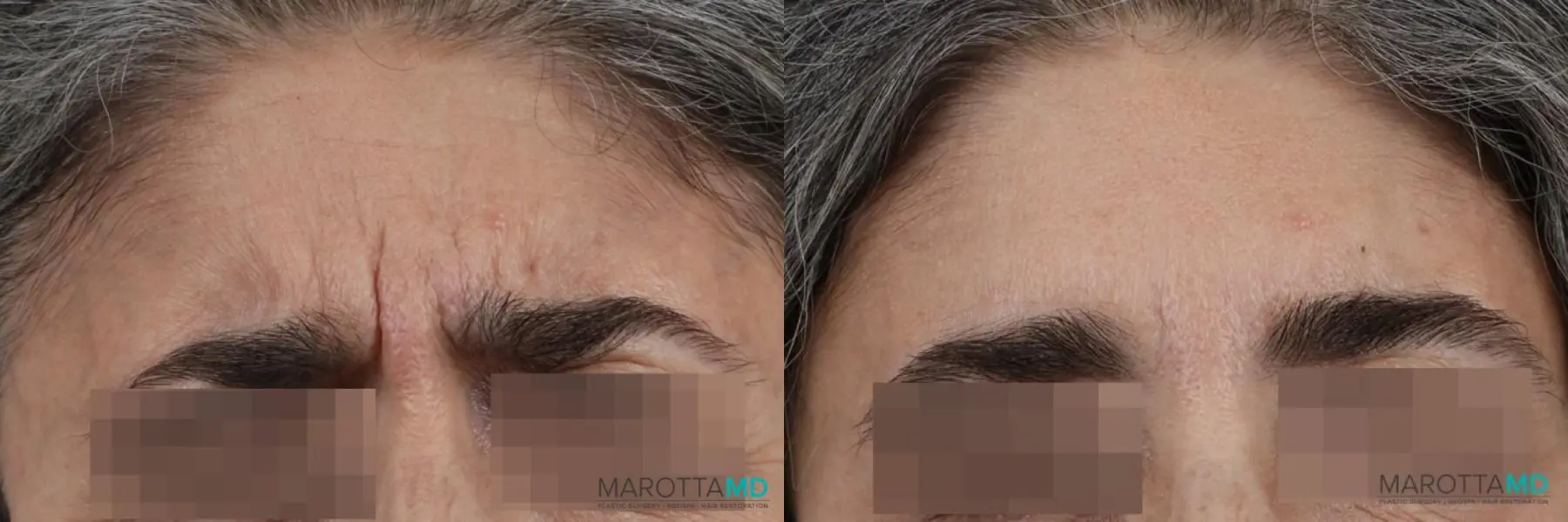 Botox - Forehead: Patient 2 - Before and After  